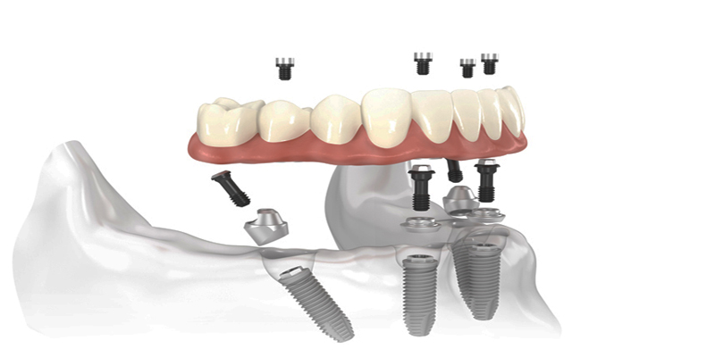 Implantes para todos os dentes em falta na PERFECT SMILE